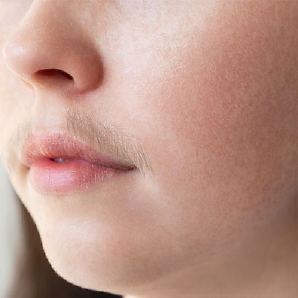 Guide about Hirsutism: Excess hair in women