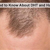 Here is Everything You Need to Know About DHT and Hair Loss