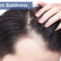 About Male Pattern Baldness- Causes, Symptoms and Treatment Options