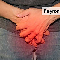 What is Peyronie's Disease and How It Can Be Treated?