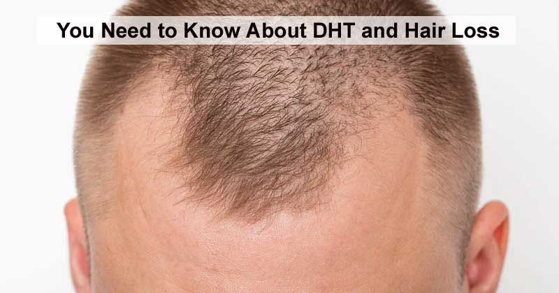 Here is Everything You Need to Know About DHT and Hair Loss