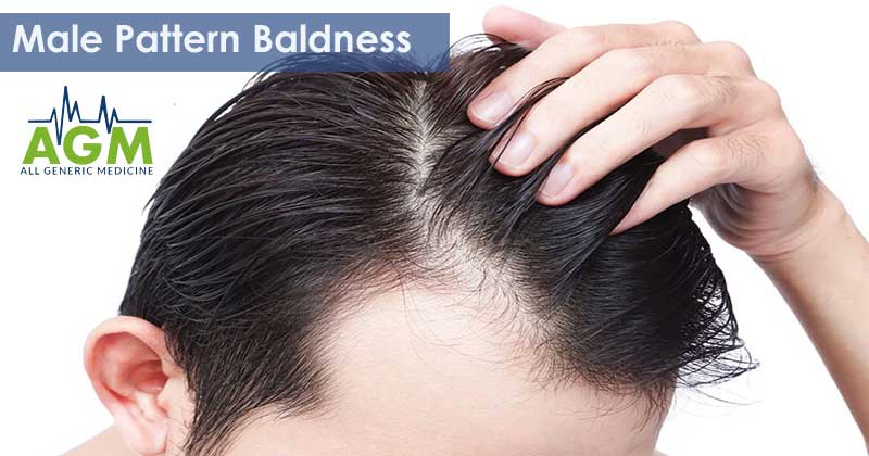 About Male Pattern Baldness- Causes, Symptoms and Treatment Options